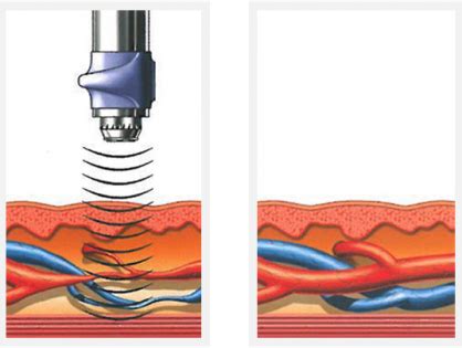 What Is Shockwave Therapy? GAINSWave Buckhead