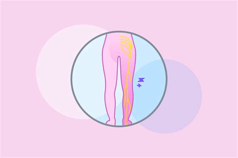 What Is The Correct Icd 10 Code For Sciatica