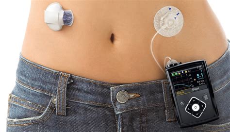 What Is The Sensitivity On A Insulin Pump? DiabetesTalk.Net