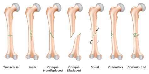 What Is a Comminuted Fracture & How It Affects Adults