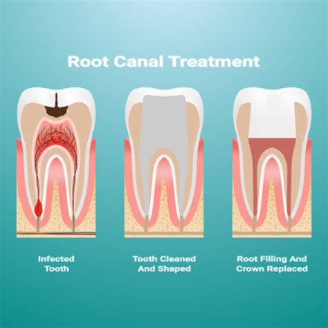 What Is a Root Canal? - lejeunedentistry.com