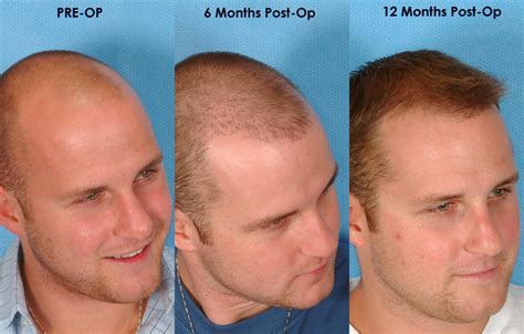 What Is the Best Hair Transplant For You?