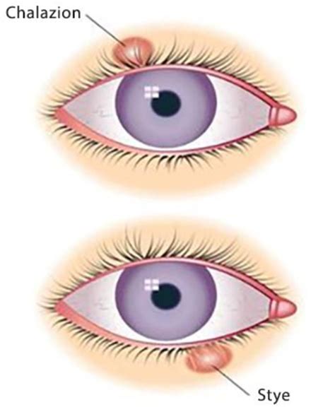What Is the Difference Between a Chalazion and a Stye HubPages