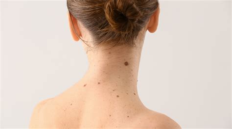 What It Means When You Have A Mole On Your Neck