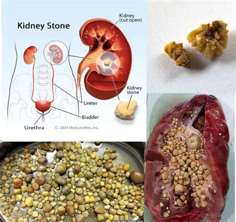 What Kidney Stones Picture is Look Like - glamyohealth.in