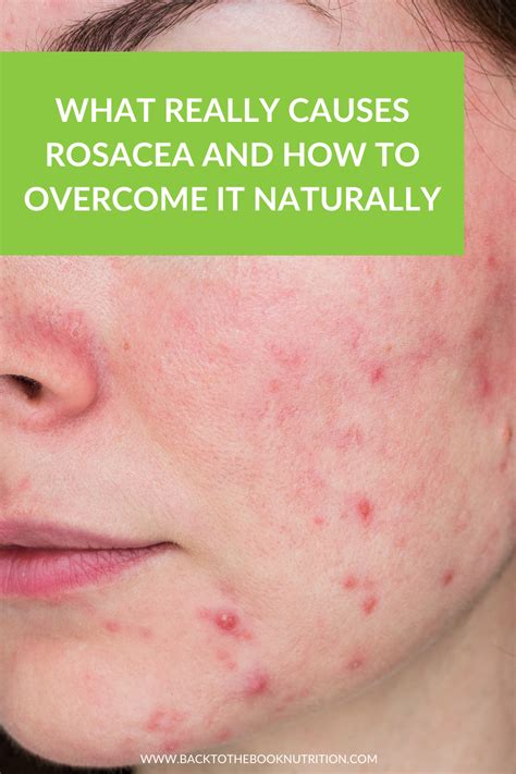 What Really Causes Rosacea and How to Overcome it Naturally