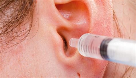 What To Do When Earwax Becomes a Problem