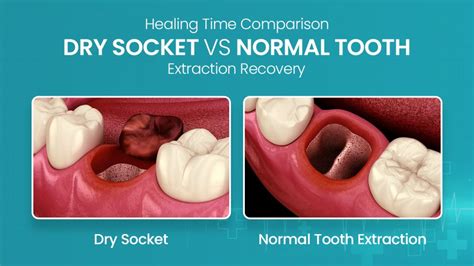 What Tooth Extraction Recovery Time Actually Looks Like