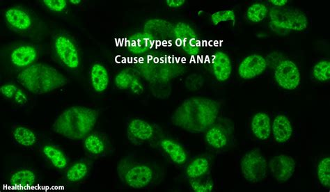 What Types of Cancer Cause Positive ANA? - Health CheckUp