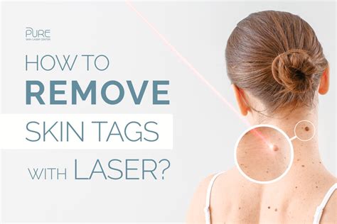 What You Don’t Know About Skin Tags - Laser Hair Removal …