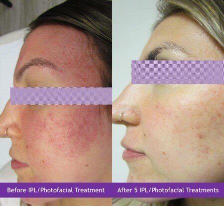 What You Need to Know About IPL Photofacials - Mara