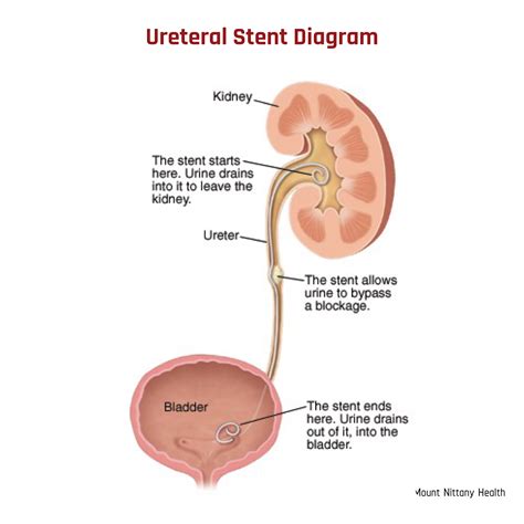 What You Need to Know About Stent in Kidney