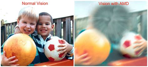 What age does bad vision start