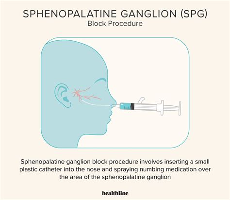 What an ‘SPG Block’ Is and How it Helps Relieve Headache Pain