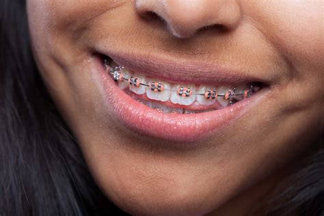 What are Teeth Spacers for Braces and Are They …