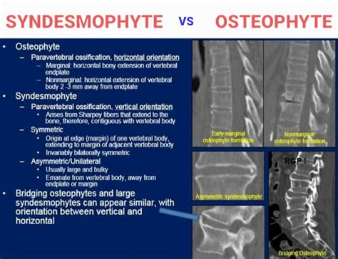 What are syndesmophytes and what is their link with AS 