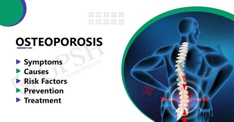 What are the causes and risk factors of osteoporosis? - MyMed.com