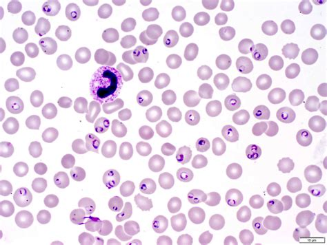 What are the characteristics of Plasmodium falciparum?