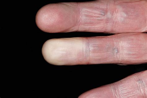 What are the effects of Raynaud