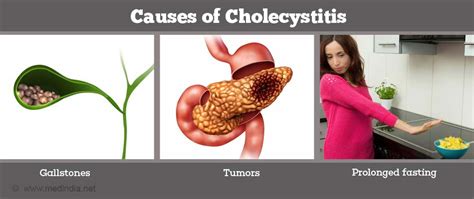 What are the most common causes of cholecystitis?