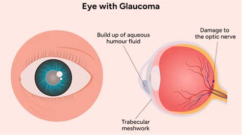 What can trigger glaucoma