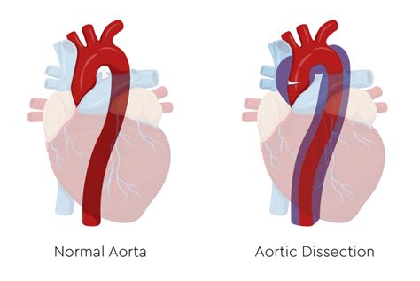 What caused john ritter aortic dissection