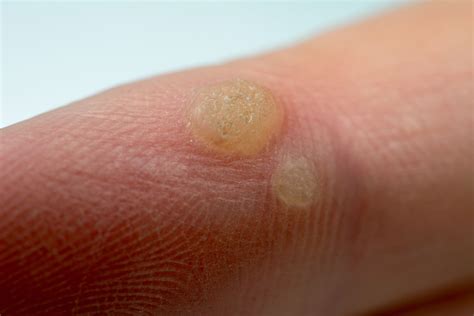 What causes a wart on finger. .  ...