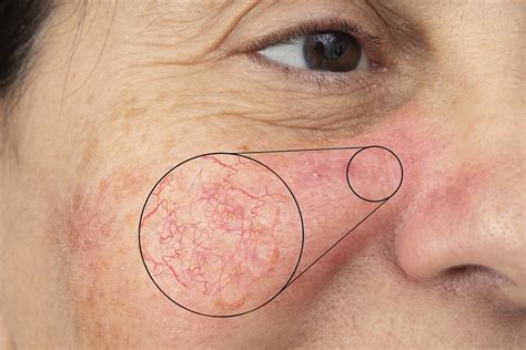 What causes broken capillaries on face