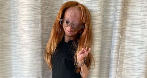 What condition does adalia rose have