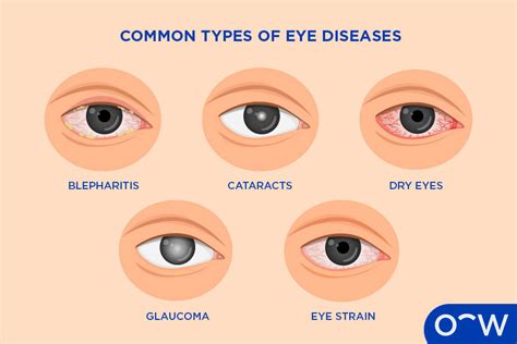 What deficiency causes eye problems