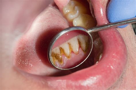 What do rotting teeth look like? - gulchlife.jodymaroni.com