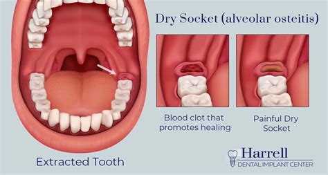 What does Developing a Dry Socket Mean Everyday Health