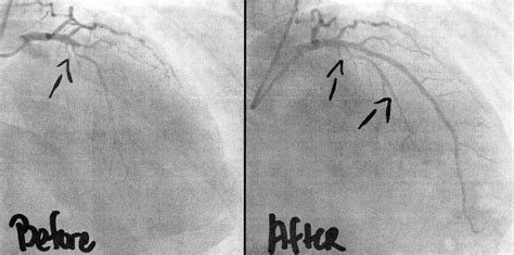 What does a angiogram show