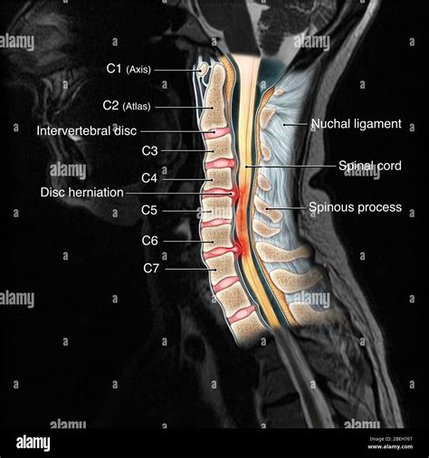 What does a cervical mri show
