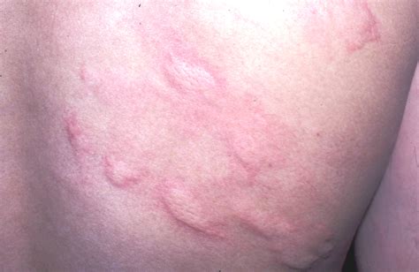 What does a food allergy rash look like?