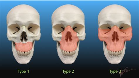 What does a fracture of maxillary spine mean for a nose, …