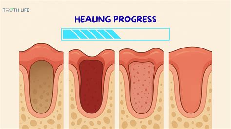 What does a healing socket look like after tooth extraction.  Learn to ...