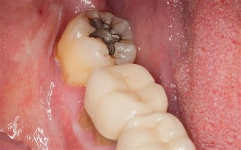 What does an arrested cavity look like.  Learn more.  does in British English...