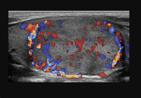 What does increased vascularity in thyroid nodule mean.  42 Evidence of e...