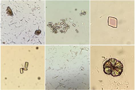 What does it mean to have many amorphous crystals in urine?