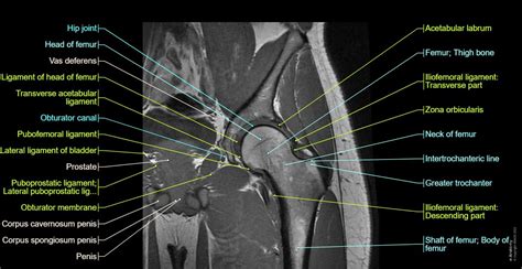 What does mri of hip show