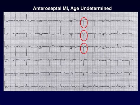 What does possible anterior infarct age undetermined mean.  Does Sentence Examples He does n...