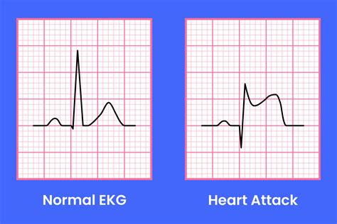What does the ecg show