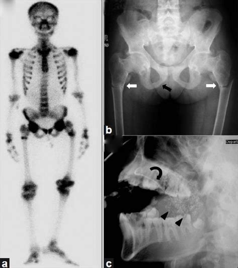 What does this mean:Diffuse increased tracer activity throughout …