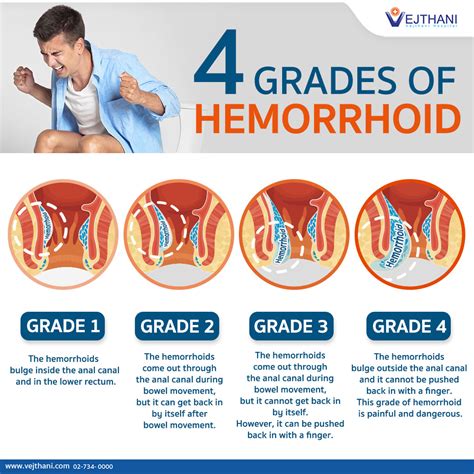 What external hemorrhoids look like and how to get …