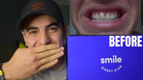 My Smile Direct Club Before and After Pictures. I really loved where “Problem Tooth #2” was positioned, I think it turned out really well. But, my biggest problem tooth, #1 above, had not progressed forward as much as I would like, …. 