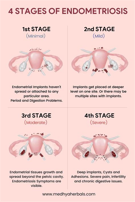 What happens to endometriosis when you