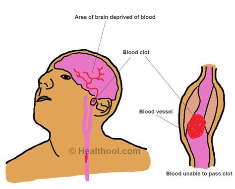 What happens when blood clots in brain