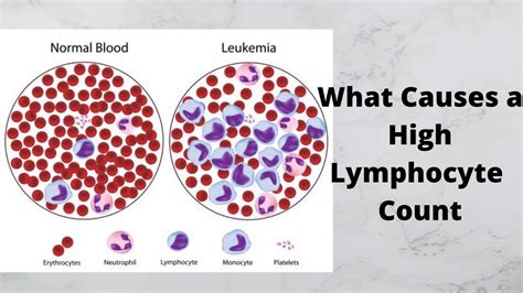 What happens when lymphocyte count is high