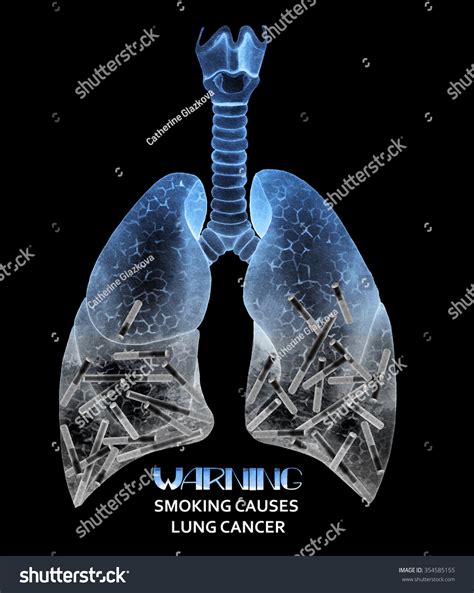 What in cigarettes causes lung cancer